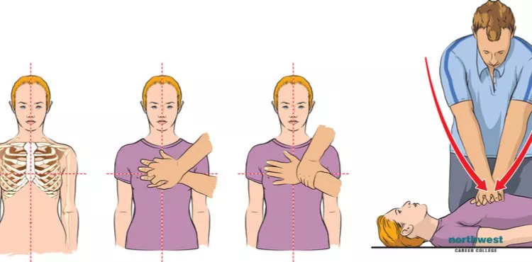 A diagram showing how does CPR work