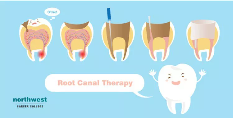 tooth with root canal therapy