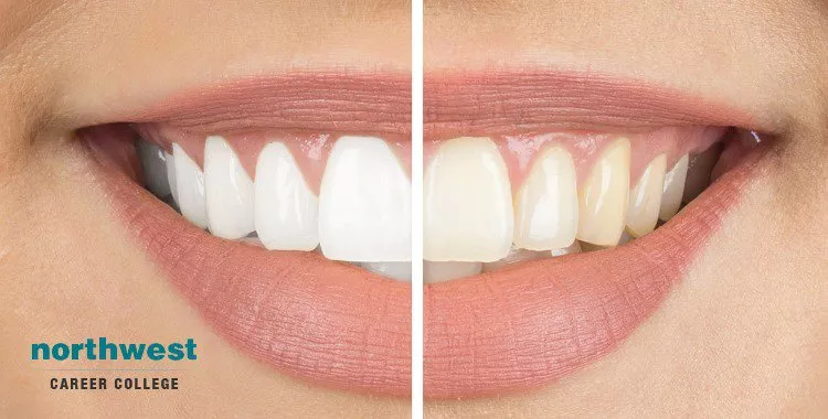 before and after Tooth Whitening